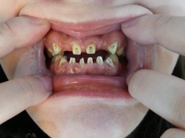 피해자 A씨 치아 상태. A씨는 9년 전 화이트치과에서 교정을 받았다가 16개의 치아를 발치하고 염증이 생기는 의료사고를 당했다.(사진=환경경찰뉴스)
