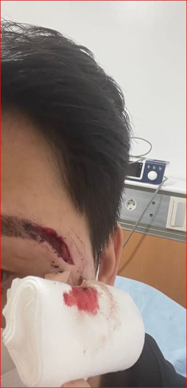송 씨는 조폭들 폭행으로 눈두덩이가 찢어지고 몸에 피멍이 드는 등 전치 3주이상의 부상을 당했다.(사진=환경경찰뉴스)